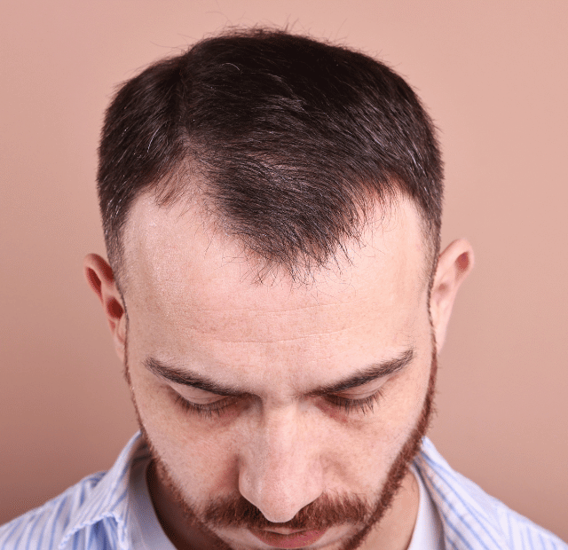 Careca ou ficando calvo Elas reparam nisso Tribo da conquista Capa Web Stories