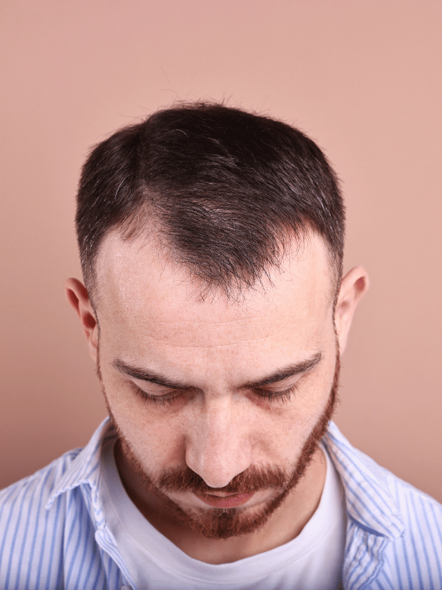 Careca ou ficando calvo? Elas reparam nisso?